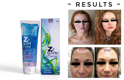 Z Glow facewash for oily & acne prone skin (70 gm)